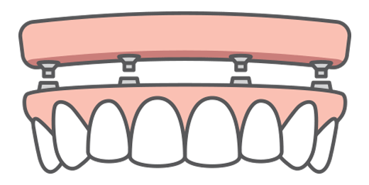 Illustration of an All-on-4 full-arch dental implant-supported bridge and how it fits onto four dental implants