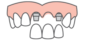 Three-tooth implant restoration ready to fill a gap by attaching it to two dental implant fixtures at each end of gap